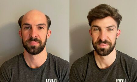 Lordhair: soluzioni rivoluzionarie per la sostituzione dei capelli